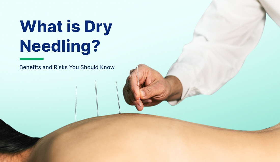 Dry Needling in Physical Therapy